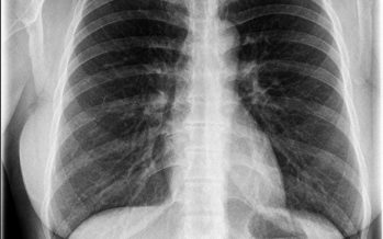 Lungenschäden bei Corona-Patienten gibt Ärzten Rätsel auf
