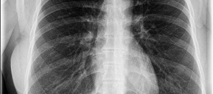 Lungenschäden bei Corona-Patienten gibt Ärzten Rätsel auf
